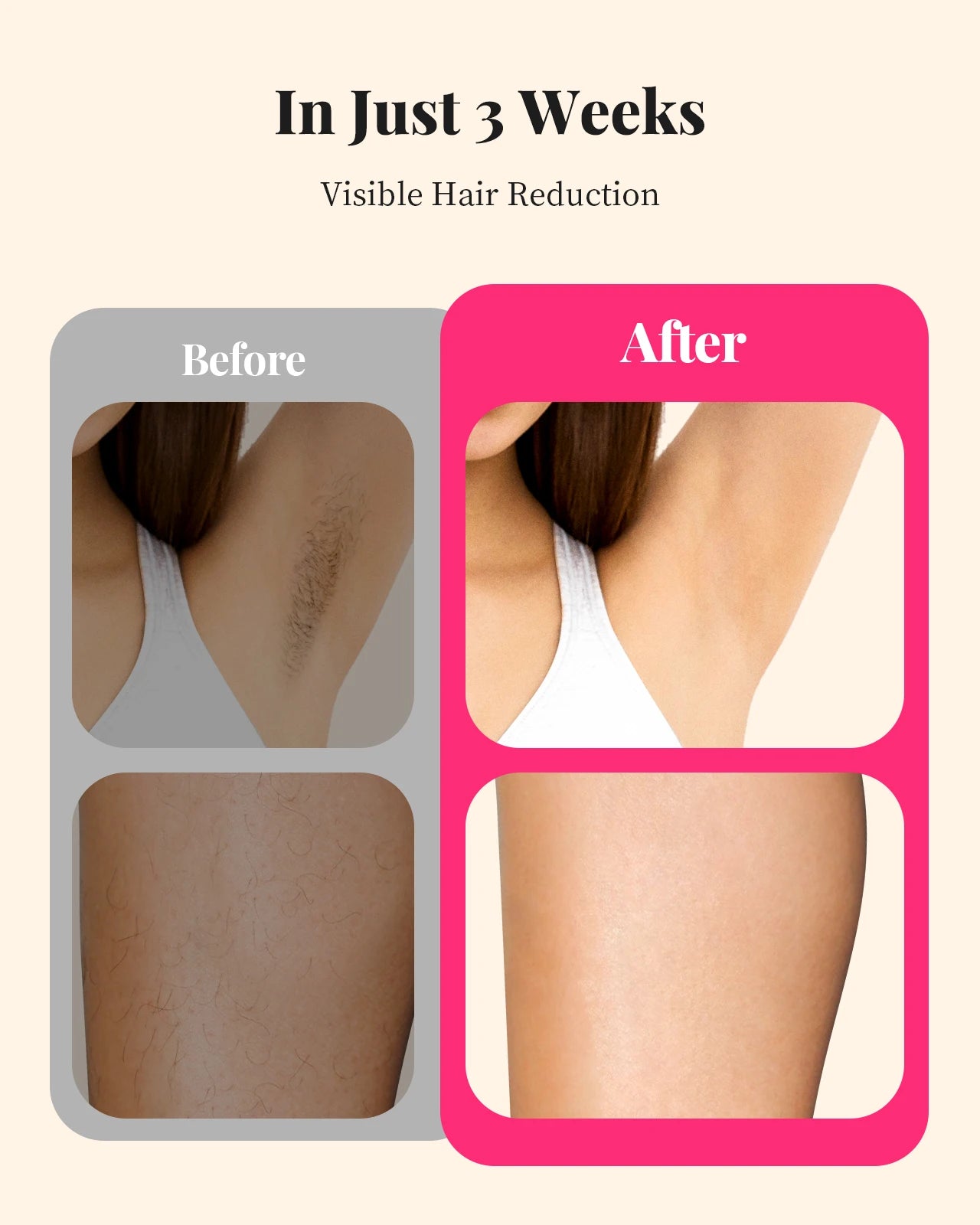 990,000 Flashes IPL Laser Hair Removal – Painless & Permanent
